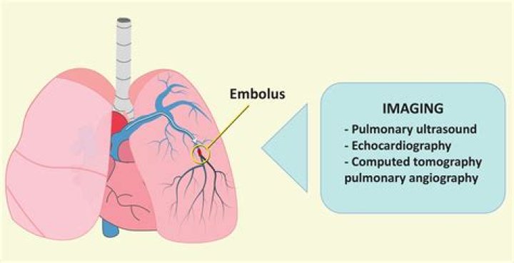 What is a pulmonary sequestration?