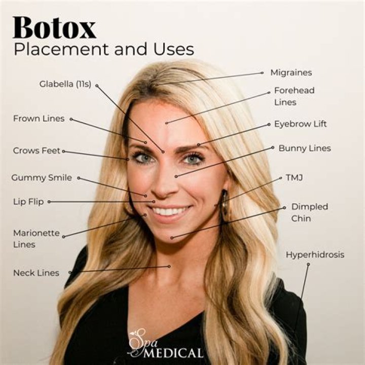 What is a smile lift Botox?