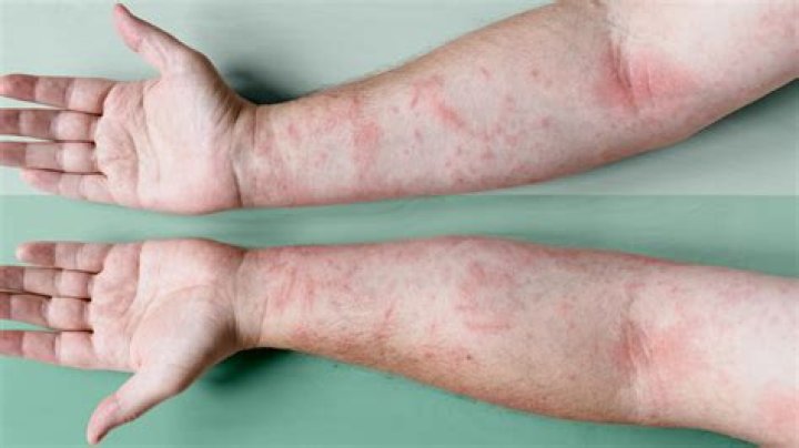 What is classed as severe eczema?