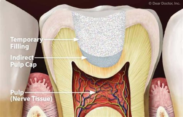 What is considered as best pulp protection?