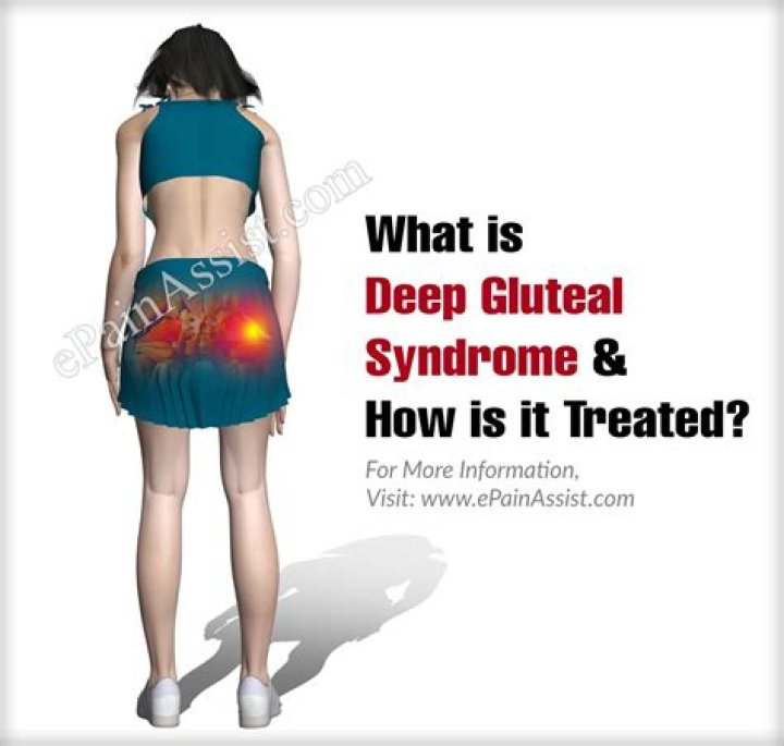 What is deep gluteal syndrome?