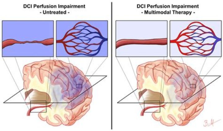 What is delayed cerebral ischemia?