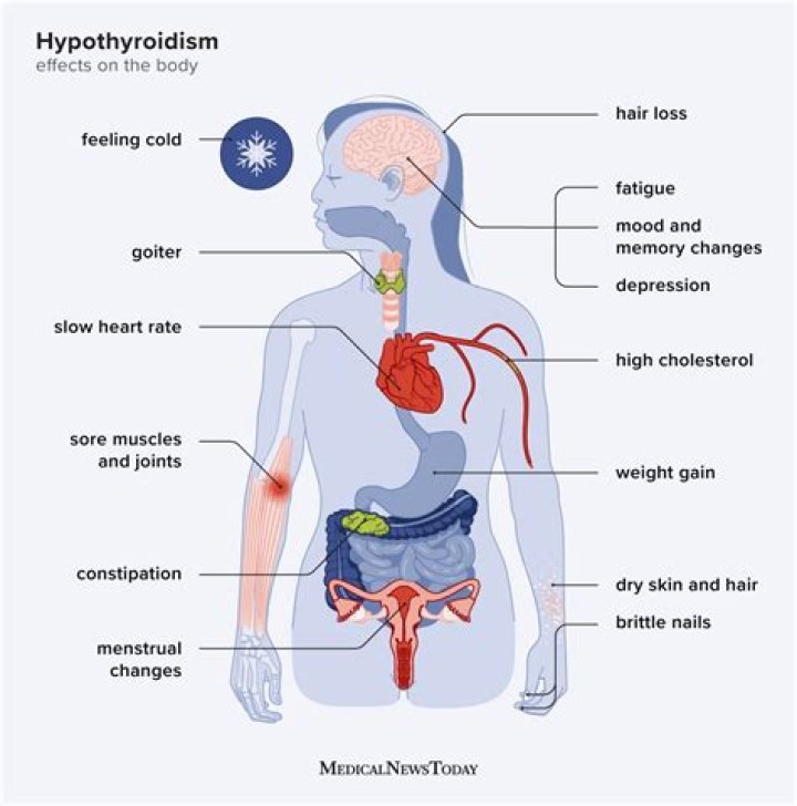 What is full blown hypothyroidism?