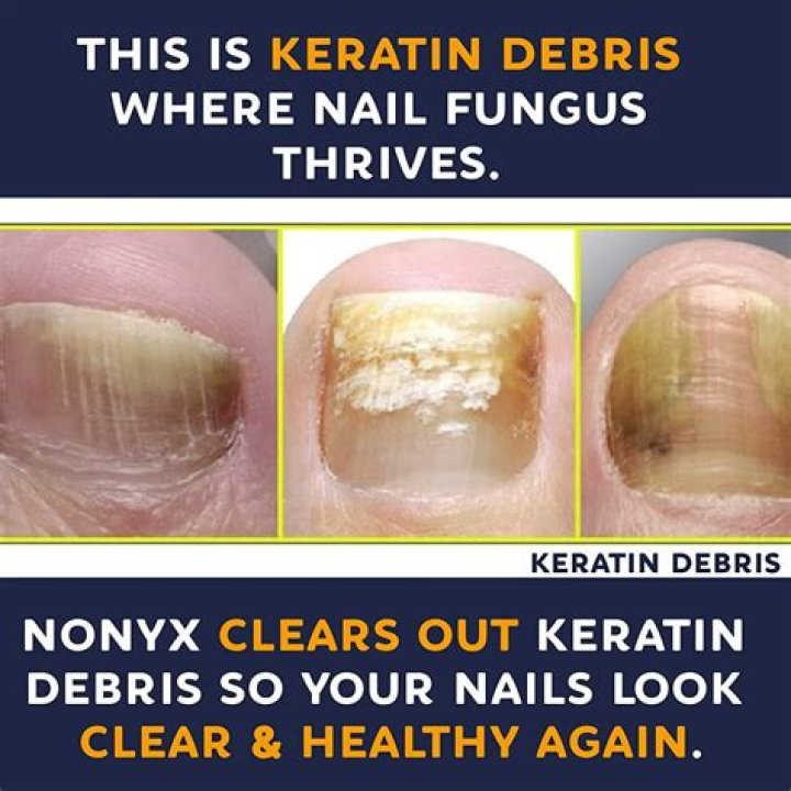What is keratin debris?