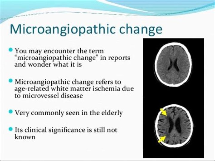 What is Microangiopathic disease?