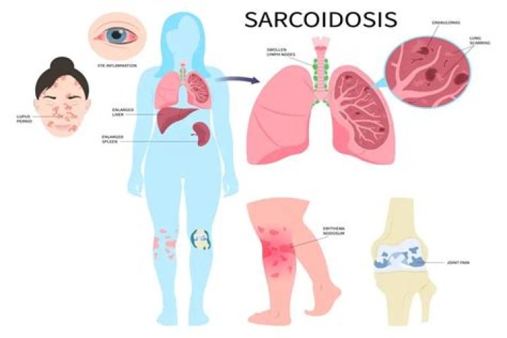 What is scar sarcoidosis?
