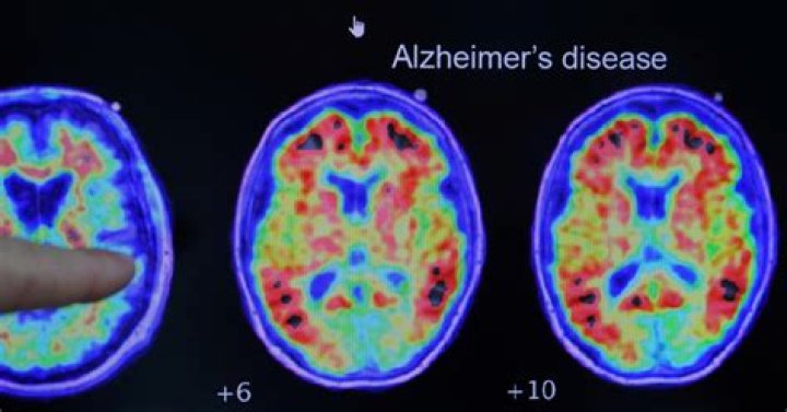 What is the Alzheimer's smell test?