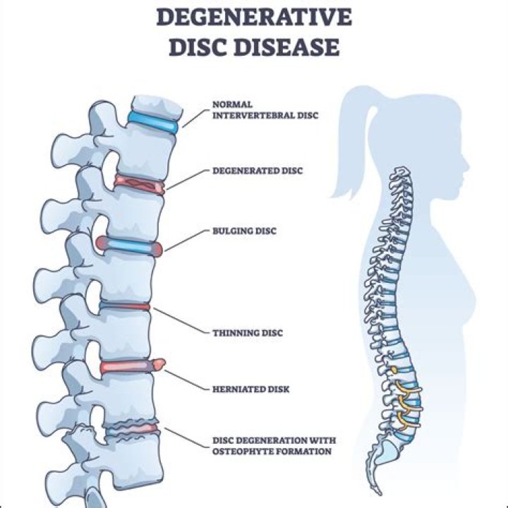 What is the best treatment for degenerative disc disease?