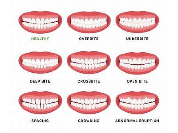 What is the correct bite for dentures?