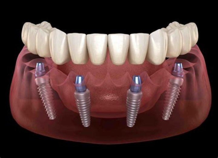 What is the maximum number of dental implants?