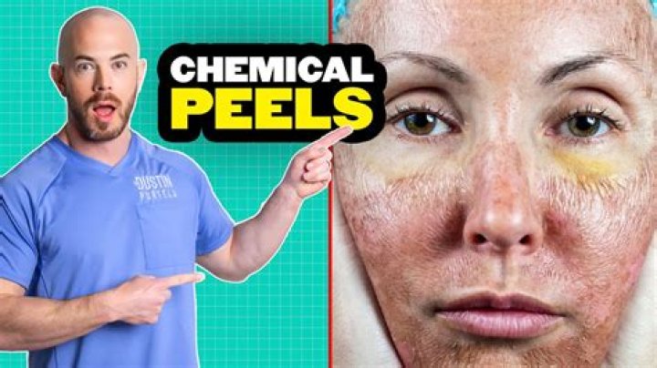 What is the strongest chemical peel you can get?