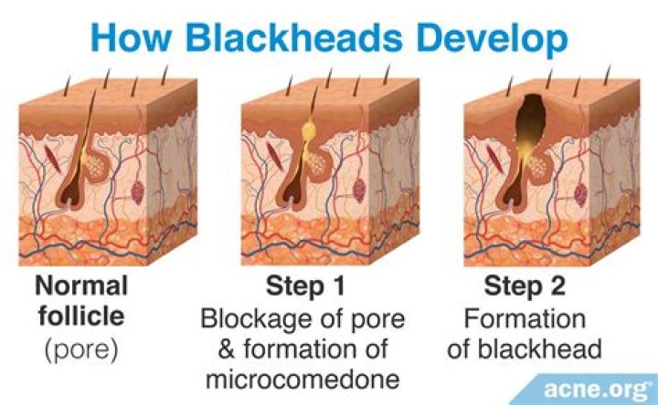 What is the stuff that comes out of a blackhead?