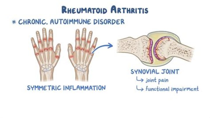 What is worse rheumatoid arthritis or osteoarthritis?