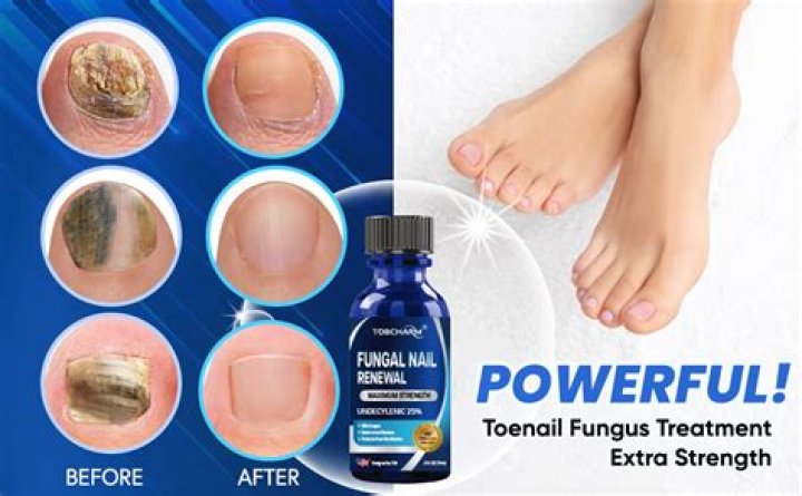 What kills black toenail fungus?