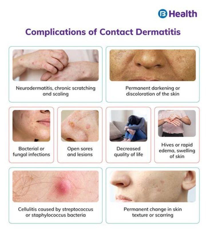 What kills contact dermatitis?