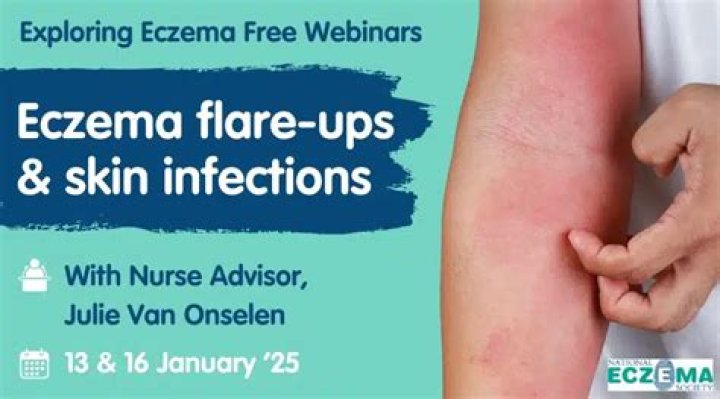 What makes eczema flare up?