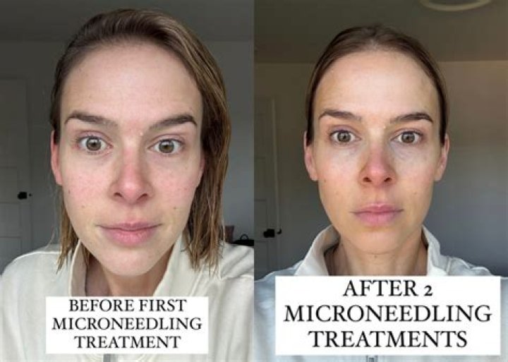 What Moisturiser can I use after microneedling?
