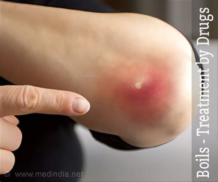 What ointment is good for boils?