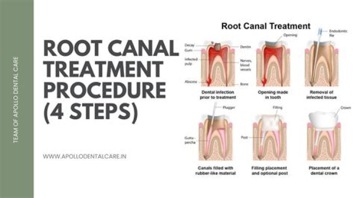 What percentage of root canals are successful?