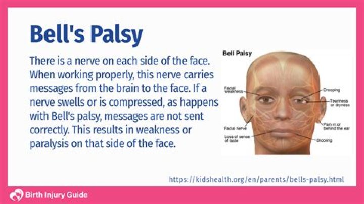 What should I not do with Bell's palsy?