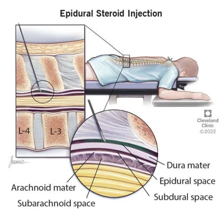 What should you not do after an epidural steroid injection?