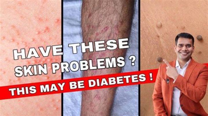 What skin problems do diabetics have?