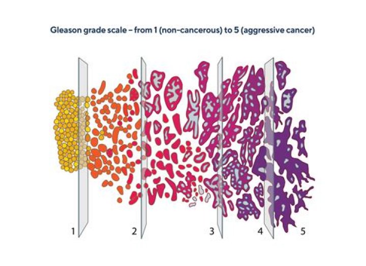 What stage cancer is a Gleason score of 9?