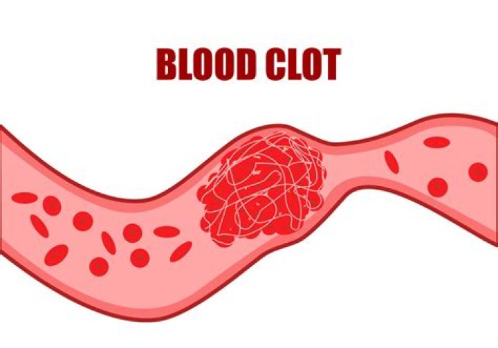 What to do if I think I have a blood clot?