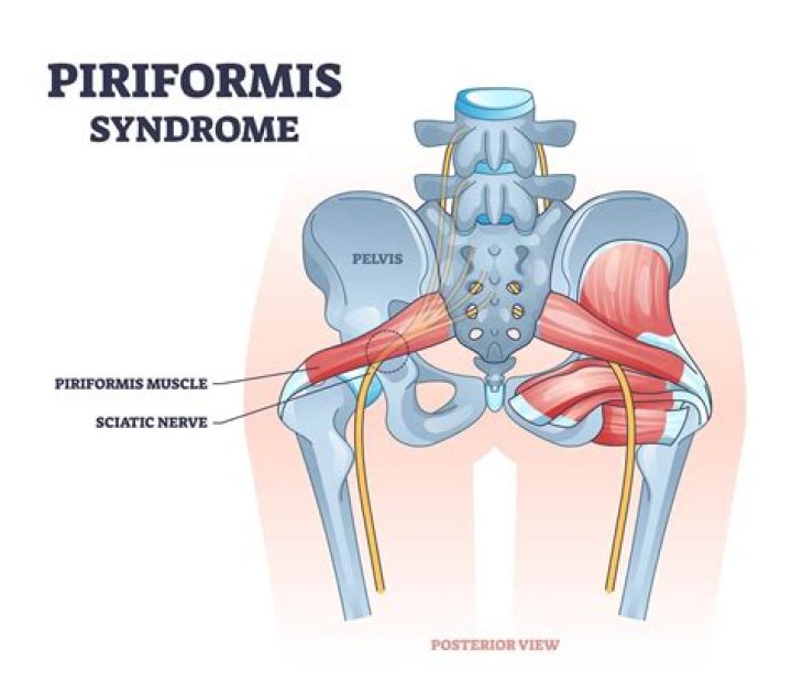 What triggers piriformis syndrome?