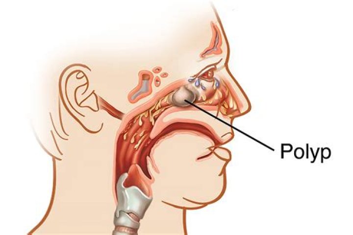 What triggers polyp?