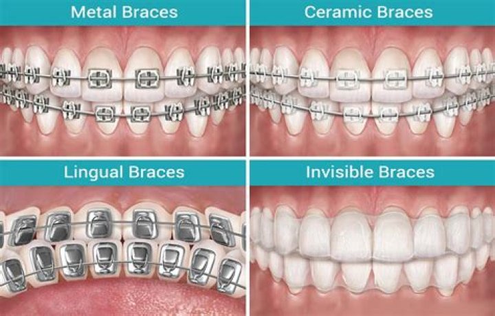 What type of braces are there?