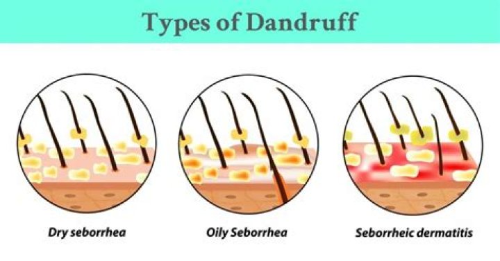What type of dandruff do I have?