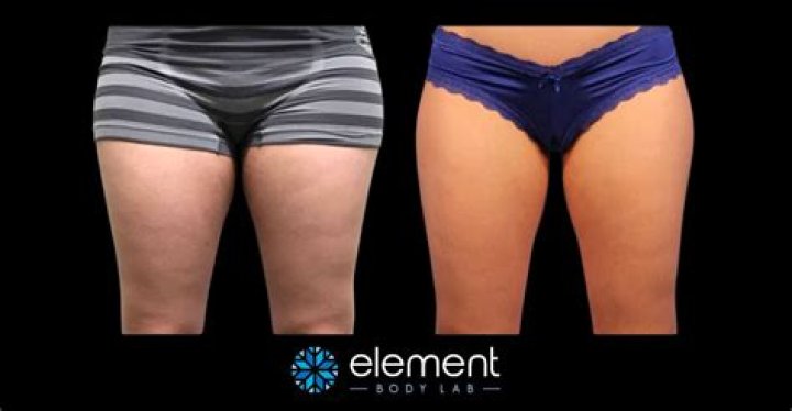 What's good for cellulite on thighs?