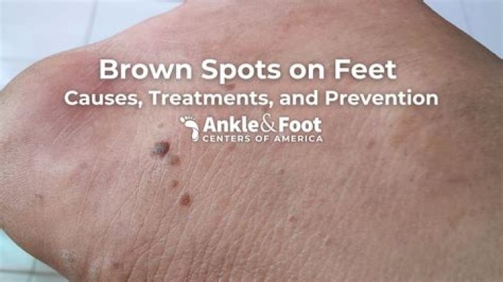 What's the difference between a liver spot and a freckle?
