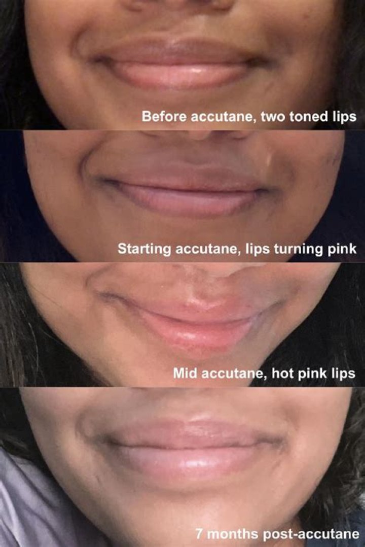 When did big lips become a trend?