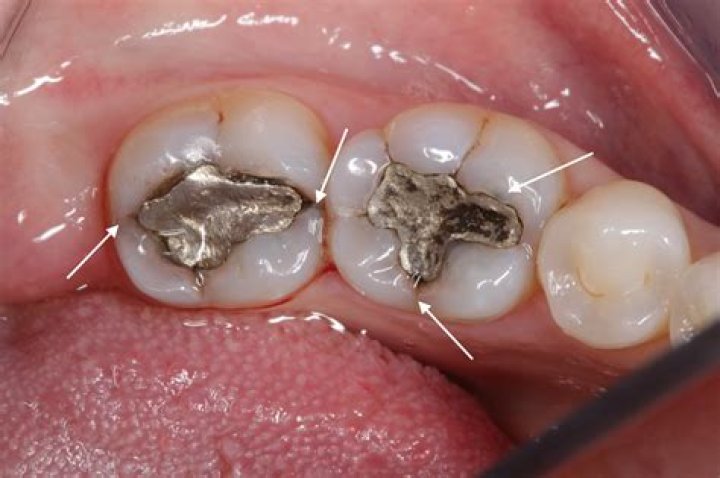 When did they stop using mercury fillings in teeth?