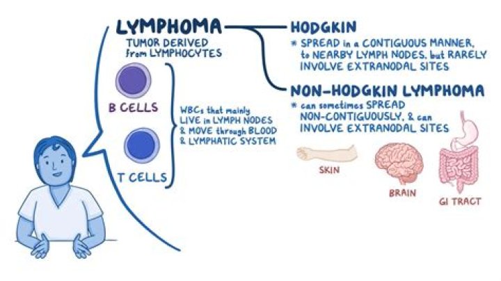 Where does Hodgkin's lymphoma start?