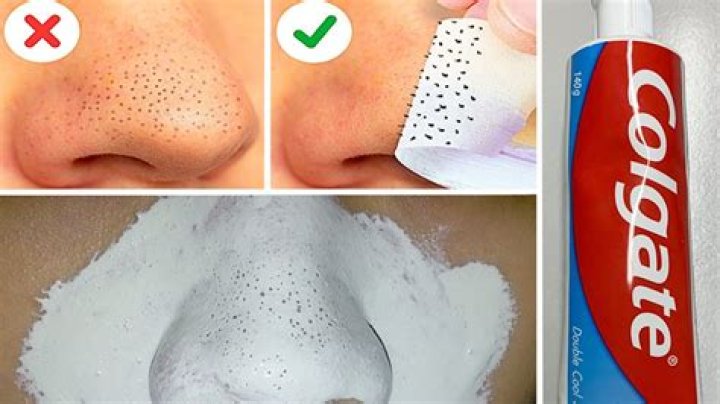 Which toothpaste is best for removing blackheads?