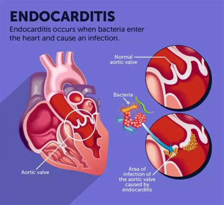 Who is at risk for bacterial endocarditis?