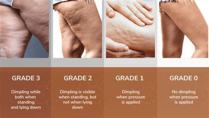 Why are my thighs so fat?