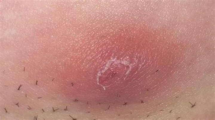 Why did my boil leave a hole?