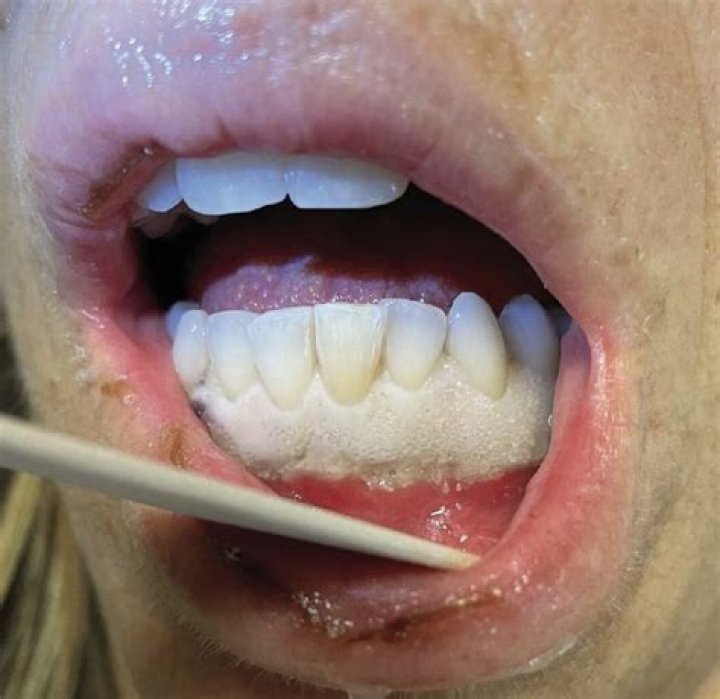 Why did my gums turn white after using peroxide?