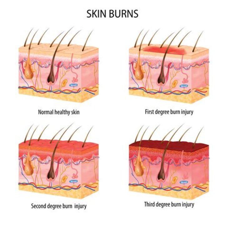 Why do burns hurt when exposed to air?