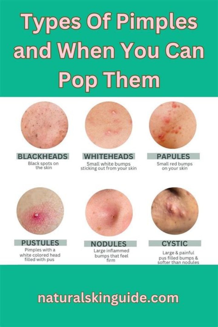 Why do dermatologists pop pimples?