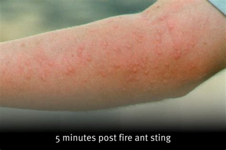 Why do fire ant bites turn into pimples?