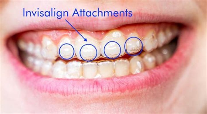 Why do I have so many attachments on my Invisalign?