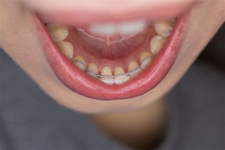 Why do retainers turn white?