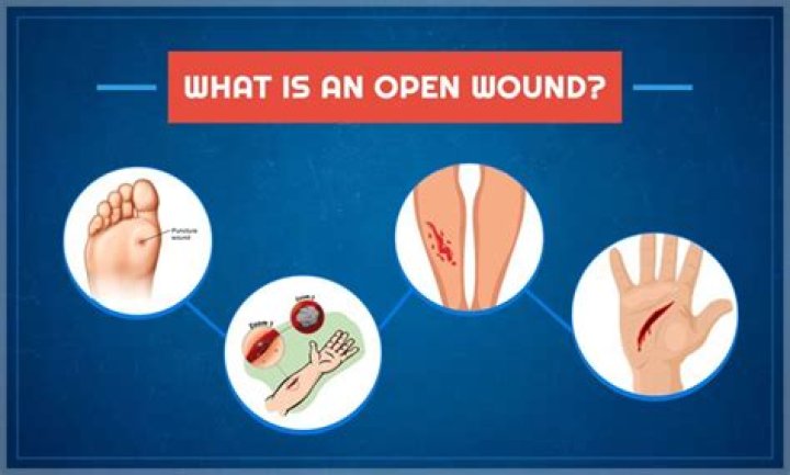 Why do surgeons leave wounds open?