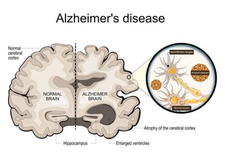 Why does Alzheimer's affect smell?