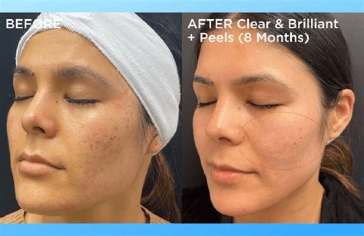 Why does my face feel like sandpaper after clear and brilliant?